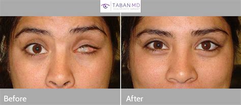 pain after eye evisceration.